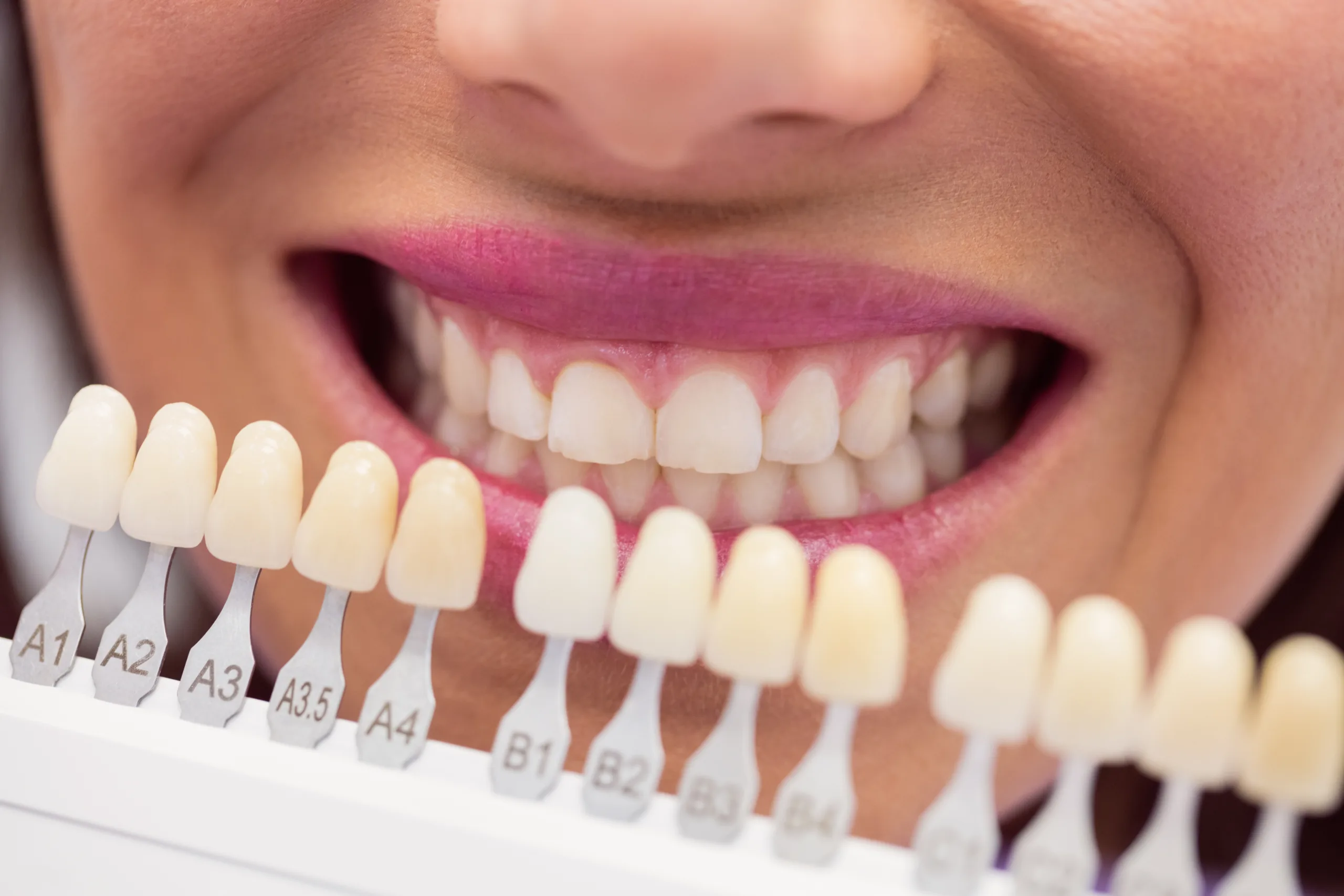 blanqueamiento dental