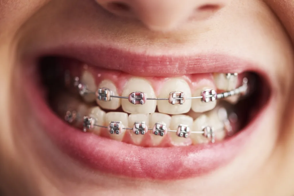 ortodoncia frenillos cuidado dental