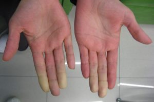 Fenómeno de Raynaud: cuando el frío y el estrés afectan la circulación sanguínea en extremidades